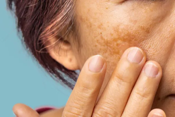 El melasma es una de las manchas más comunes y difíciles de tratar en la piel. En este artículo de CDERMA descubrirás cómo eliminar melasma definitivamente, qué opciones...