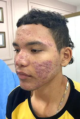 img-Acne Scars Cali-1-LCP