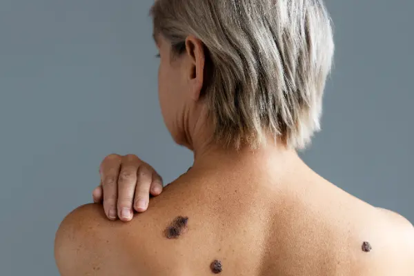 Conocer cómo identificar lunares cancerígenos es fundamental para cuidar nuestra salud y evitar complicaciones. En este artículo de CDERMA, te guiaremos para que puedas distinguir señales de alerta en tus...